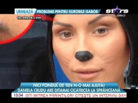 Daniela Crudu a rămas cu cicatrici VIZIBILE, după ce și-a spart capul la "Splash! Vedete la apă"