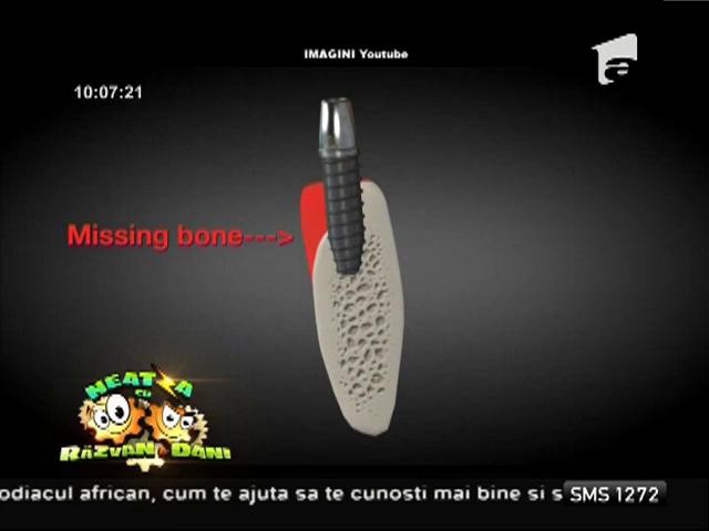 Bună dimineaţa, sănătate! Despre adițiile de os &icirc;n cazul unui implant dentar