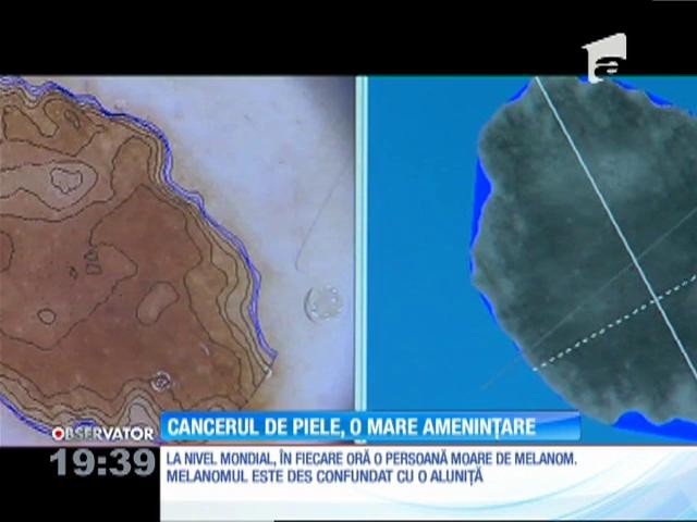 Cancerul de piele, o mare ameninţare