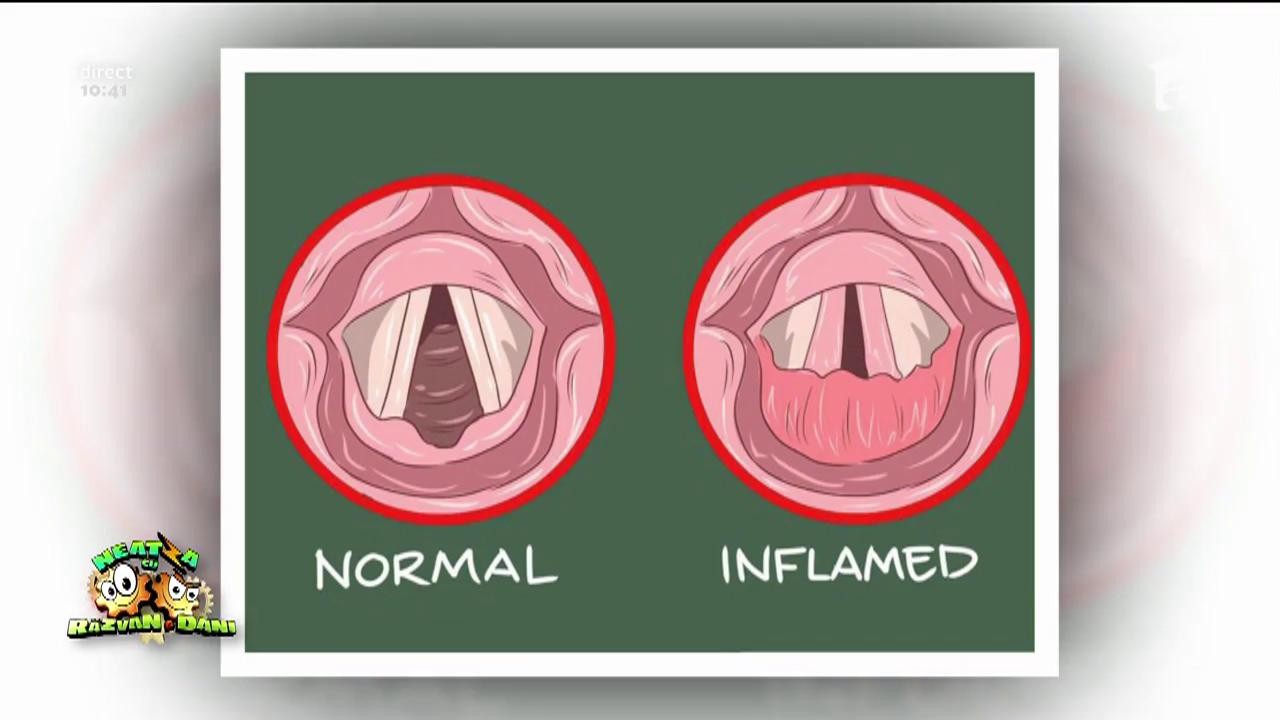 Bună dimineaţa, sănătate! Laringita: cauze, simptome, tratament