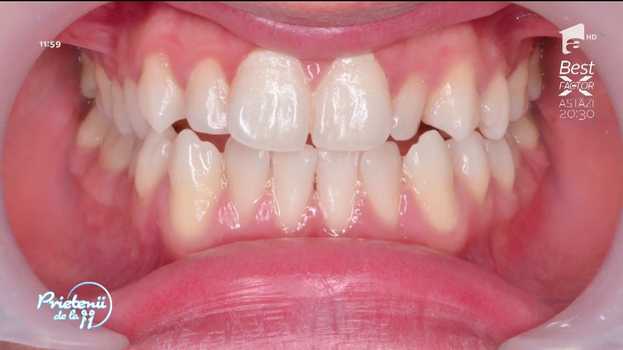 De ce este important să &icirc;ndreptăm dinţii la copii?