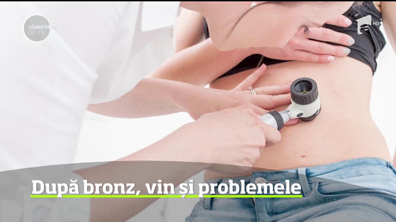 După o vară petrecută la soare, este recomandată o vizită la dermatolog, pentru a investiga aluniţele