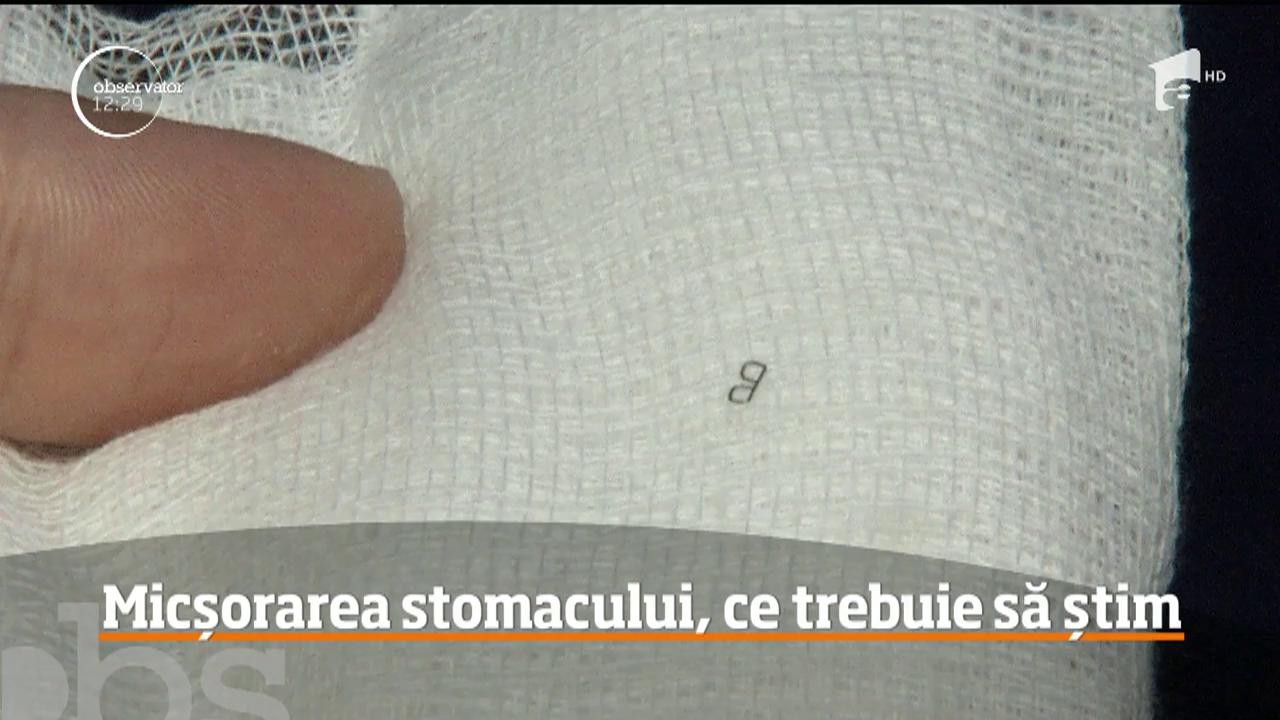 Operaţiile chirugicale de micşorare a stomacului sau inelele gastrice sunt soluţii &icirc;mpotriva grăsimii &icirc;n exces