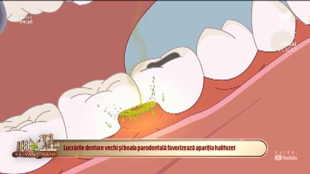 Bună dimineața, Sănătate! Cum să scapi de halitoza, mirosul neplăcut al gurii