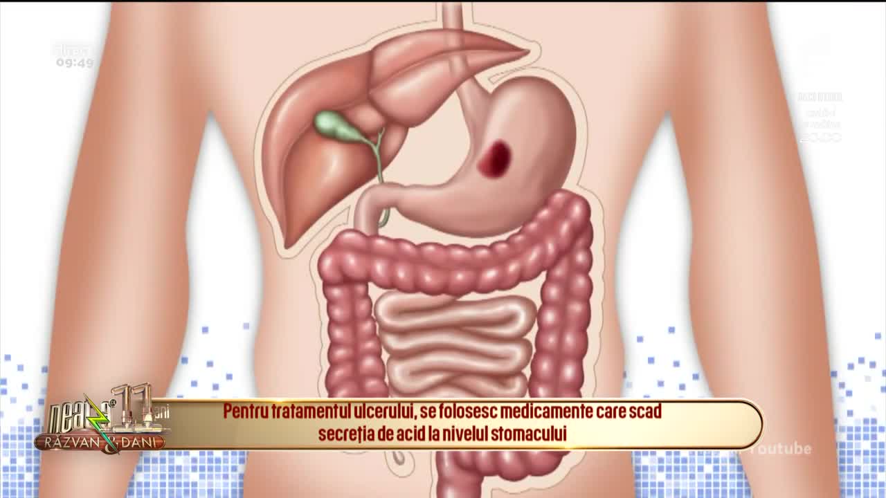 Neatza cu Răzvan și Dani - Bună dimineața, Sănătate! Ulcerul gastric, de la cauze și simptome, la tratament