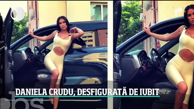 Daniela Crudu a fost desfigurată de iubit. &Icirc;ntr-o criză de gelozie, croatul a lovit-o cu bestialitate pe fosta asistentă