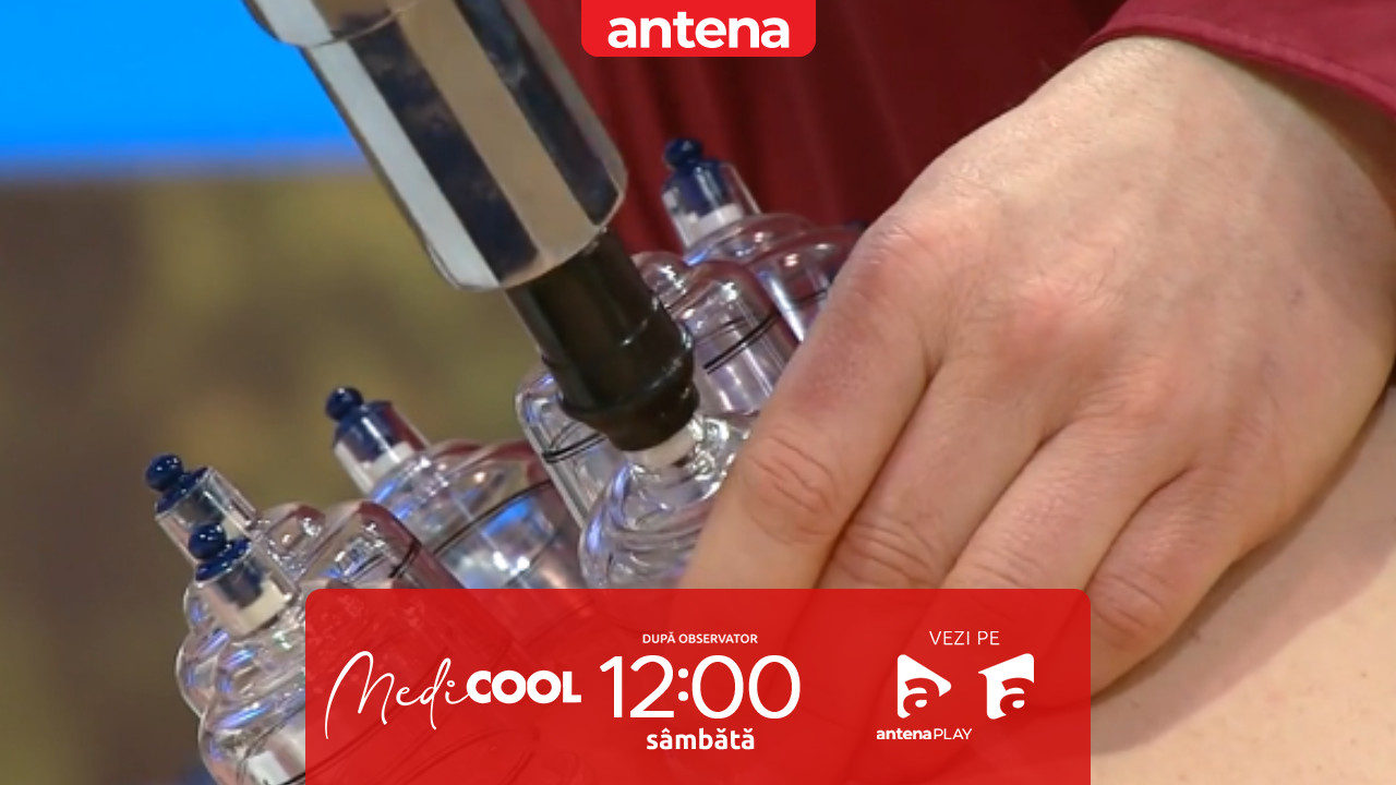 Medicool | Sezonul 10. Masajul cu ventuze: cum funcționează și c&acirc;nd poate ajuta