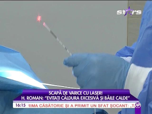 Scapa de varice cu laser!