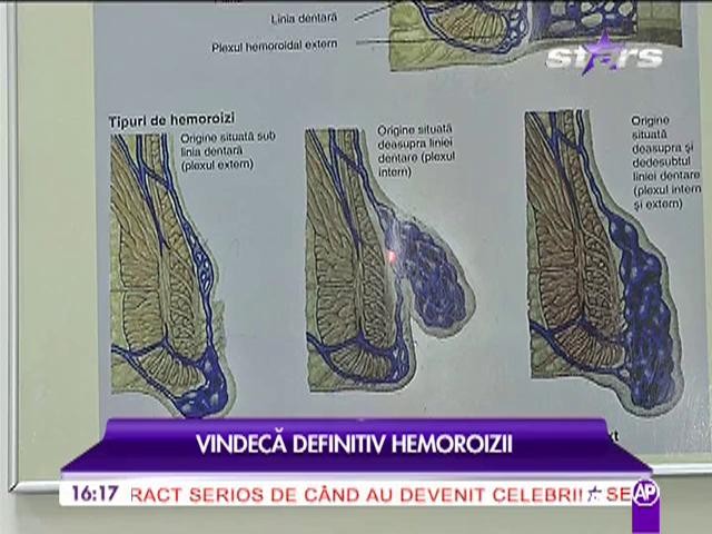 Cum putem să ne tratăm de hemoroizi