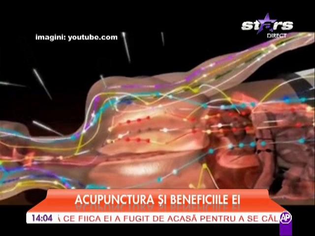 Acupunctura şi beneficiile ei