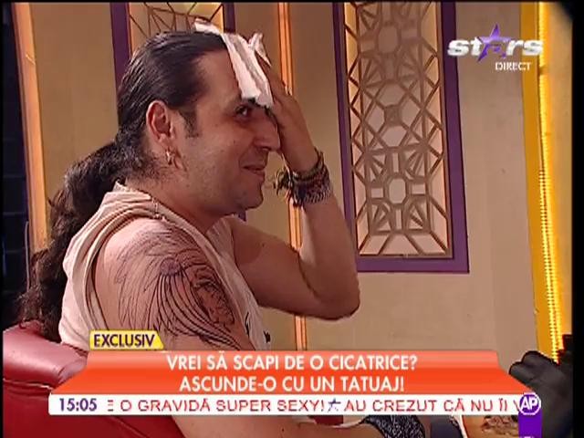 Vrei să scapi de o cicatrice? Ascunde-o cu un tatuaj!