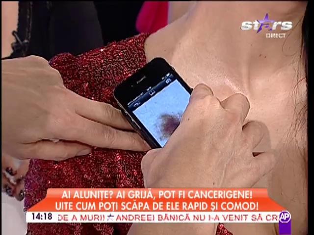 Ai aluniţe? Ai grijă, pot fi cancerigene! Uite cum poţi scăpa de ele comod şi rapid