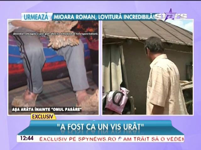 "Omul-pasăre" se &icirc;ncălţa cu papuci făcuţi din anvelope! Cum a reuşit să scape de o boală groaznică?