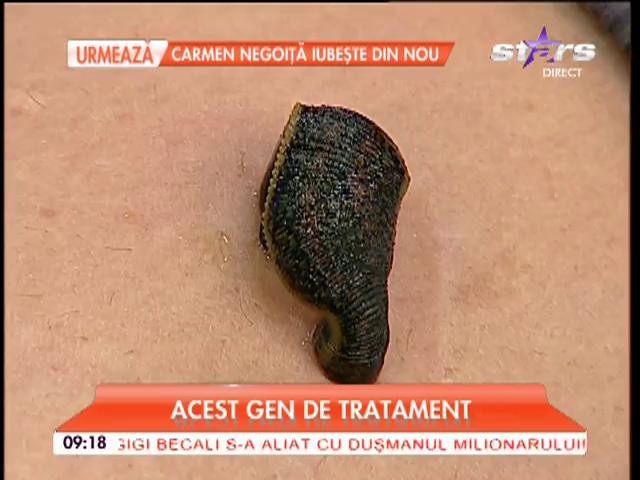 Răzvan Botezatu, supus unei terapii cu lipitori, &icirc;n direct: "Aa nu doare, nu am simţit nimic!"