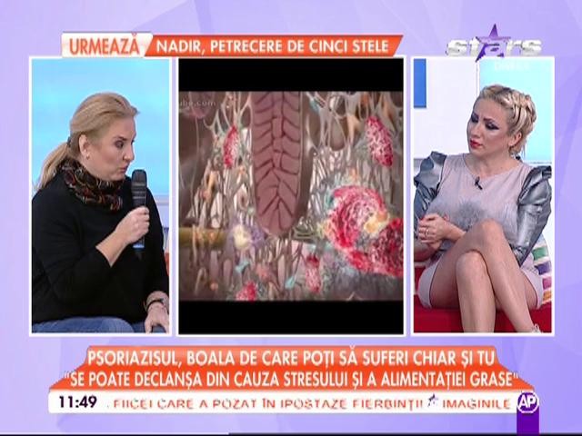 Suferi de psoriazis? Specialiştii &icirc;ţi spun totul despre această boală şi cum poate fi ţinută ea &icirc;n fr&acirc;u