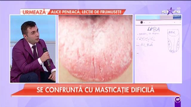 Limba, primul organ care te anunță că ești bolnav. V&acirc;rful limbii foarte roșu, probleme la inimă
