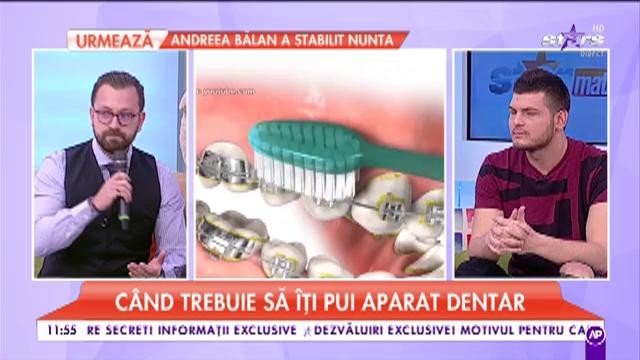 Vrei să ai z&acirc;mbet de reclamă? Aparatul dentar este soluția!