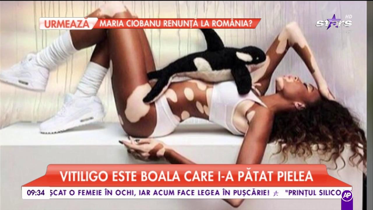 Winnie Harlow, modelul cu pielea &icirc;n două culori