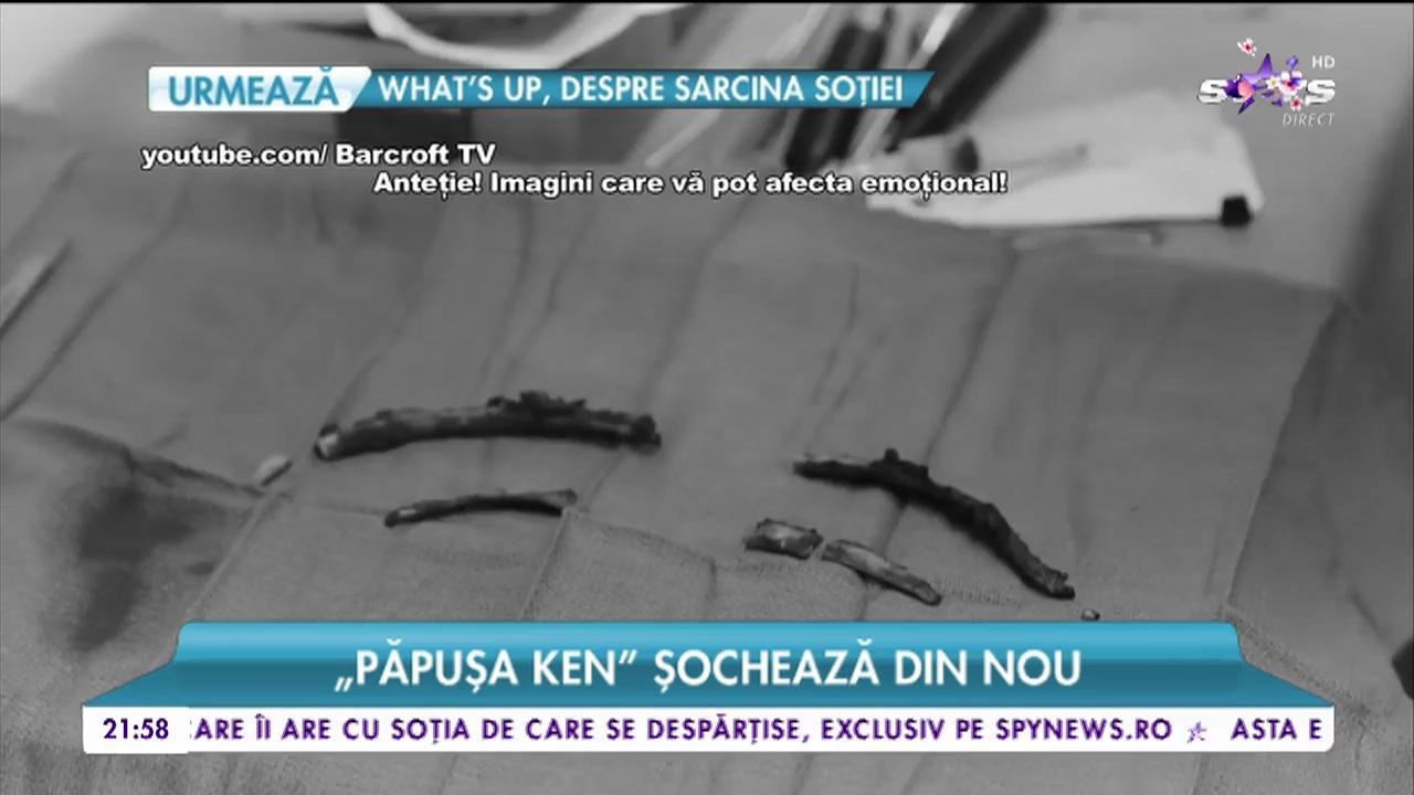 &rdquo;Păpușa Ken&rdquo; sochează din nou. Bărbatul și-a scos patru coaste