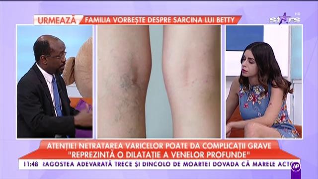 Un român din doi suferă de varice: „Varicele pot provoca tumori abdominale”