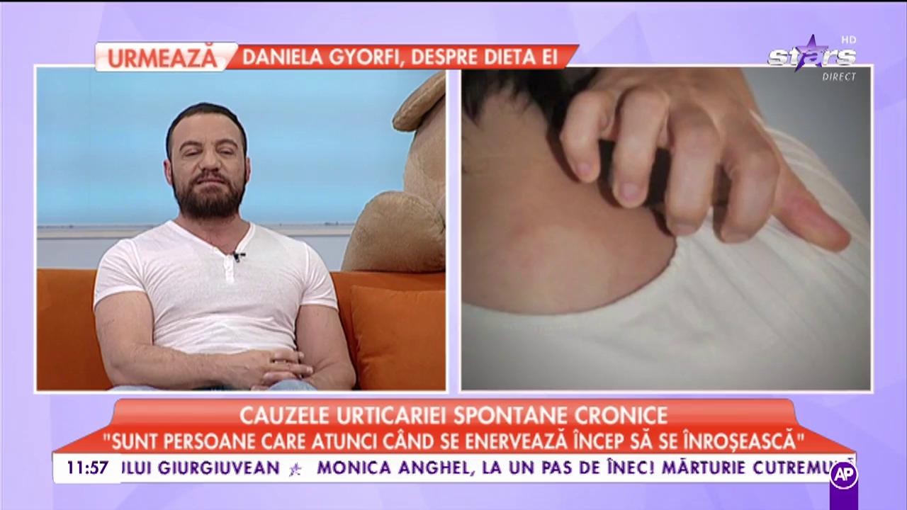 Aveți o iritație pe piele și mâncărime greu de suportat? Cum pote fi tratată urticaria spontană cronică