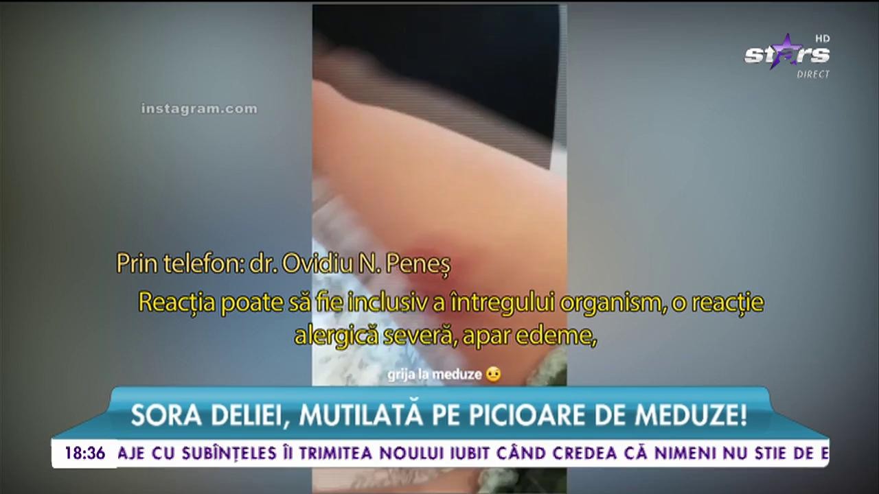 Sora Deliei, mutilată pe picioare de meduze