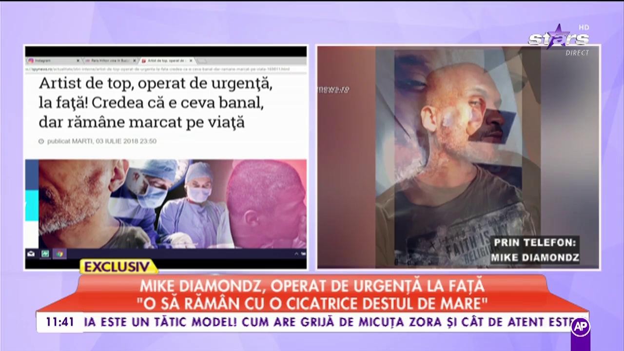 Mike Diamondz, operat de urgenţă la faţă: "O să rămân cu o cicatrice destul de mare"